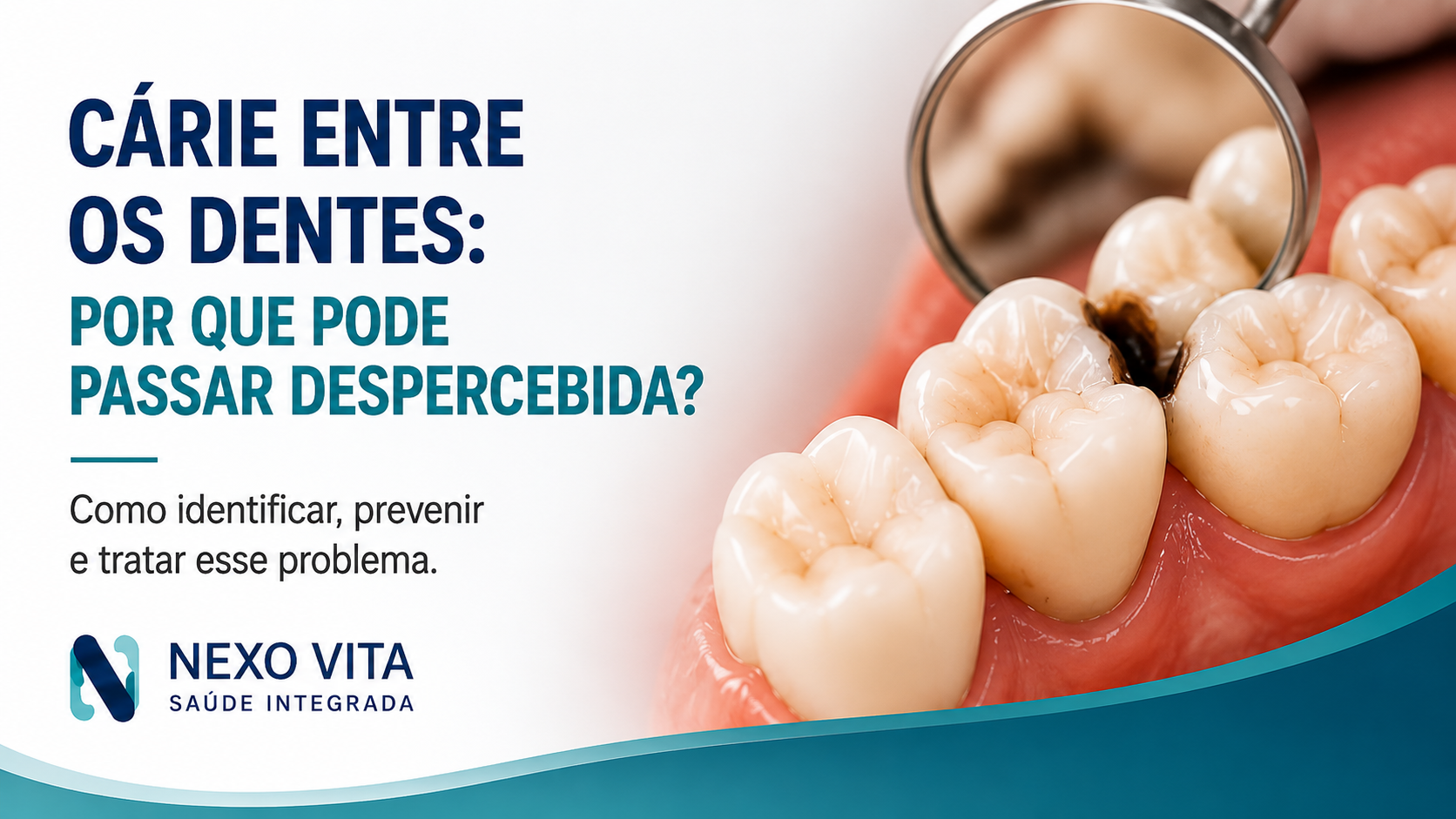 Ilustração mostrando cárie na região de contato entre dois dentes