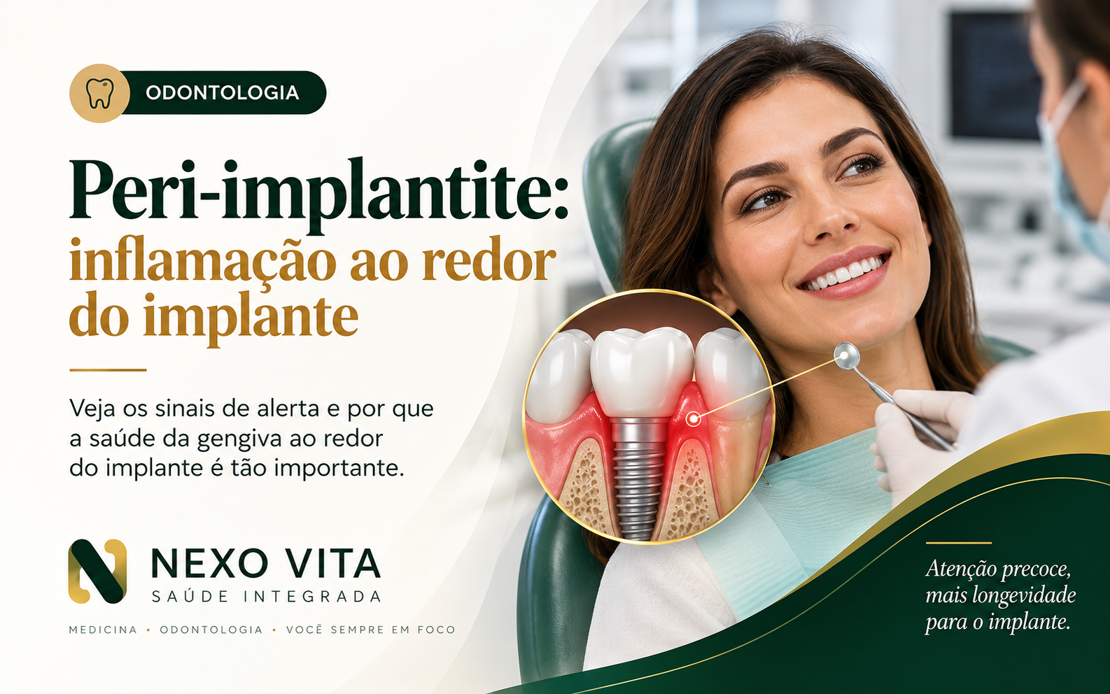 Modelo odontológico de implante dentário com representação educativa de inflamação ao redor