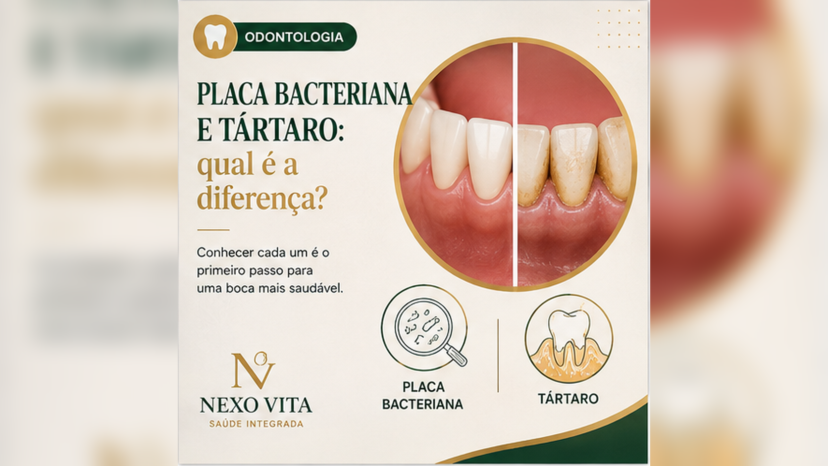 Ilustração odontológica comparando placa bacteriana e cálculo dental